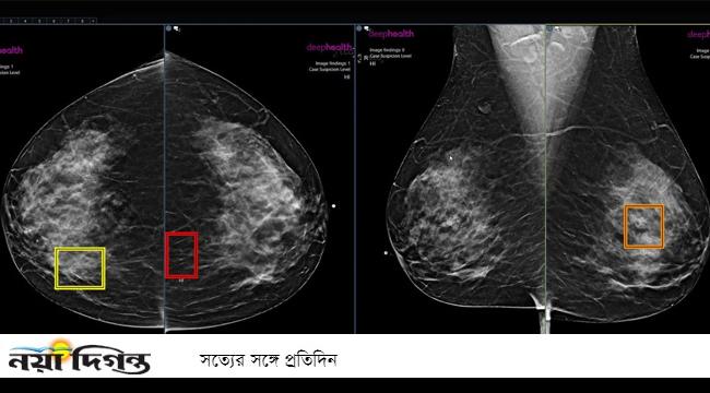 স্তন ক্যান্সার শনাক্তে ভূমিকা রাখবে এআই!