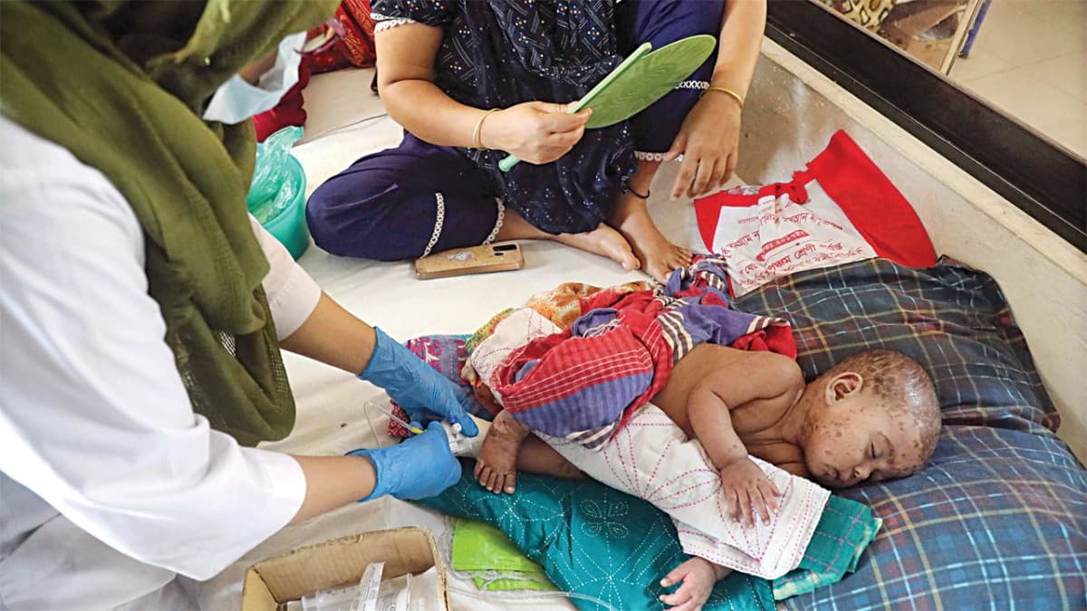 হাম উপসর্গে আরো ৪ জনের মৃত্যু, নতুন রোগী ১৪২৮
